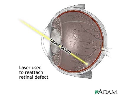 retina-laser