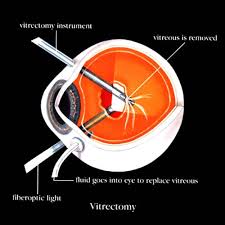 vitrectomy