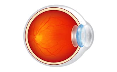 Implantable Contact Lens