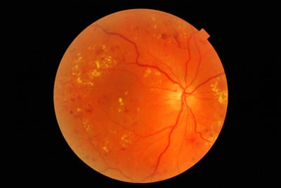 Diabetic Retinopathy