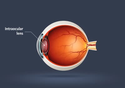 Intraocular Lens.