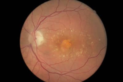 Macular Degeneration