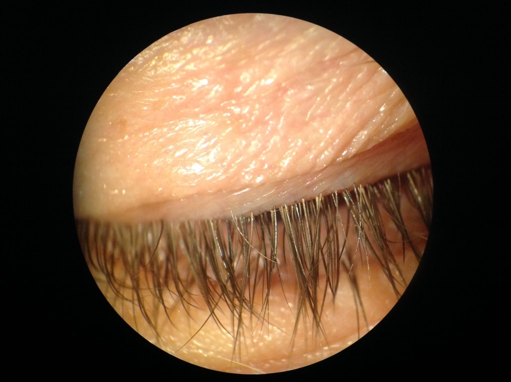 Mild Blepharitis After