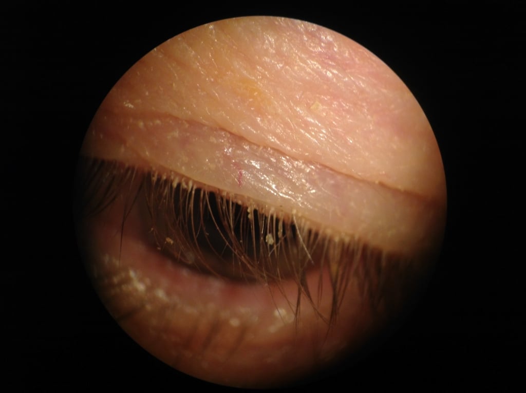 Moderate blepharitis before