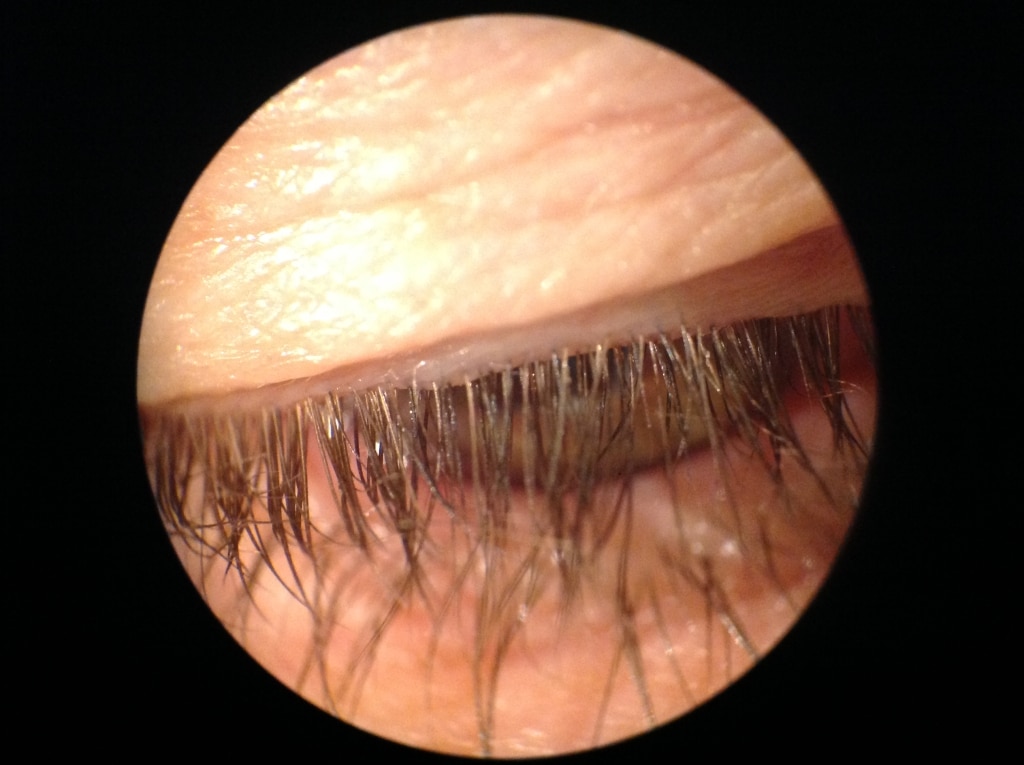 Mild Blepharitis Before