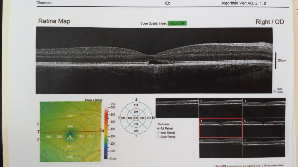 right laser OCT